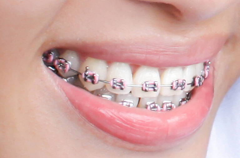 What types of brackets can we use for Orthodontic Treatment? Smile