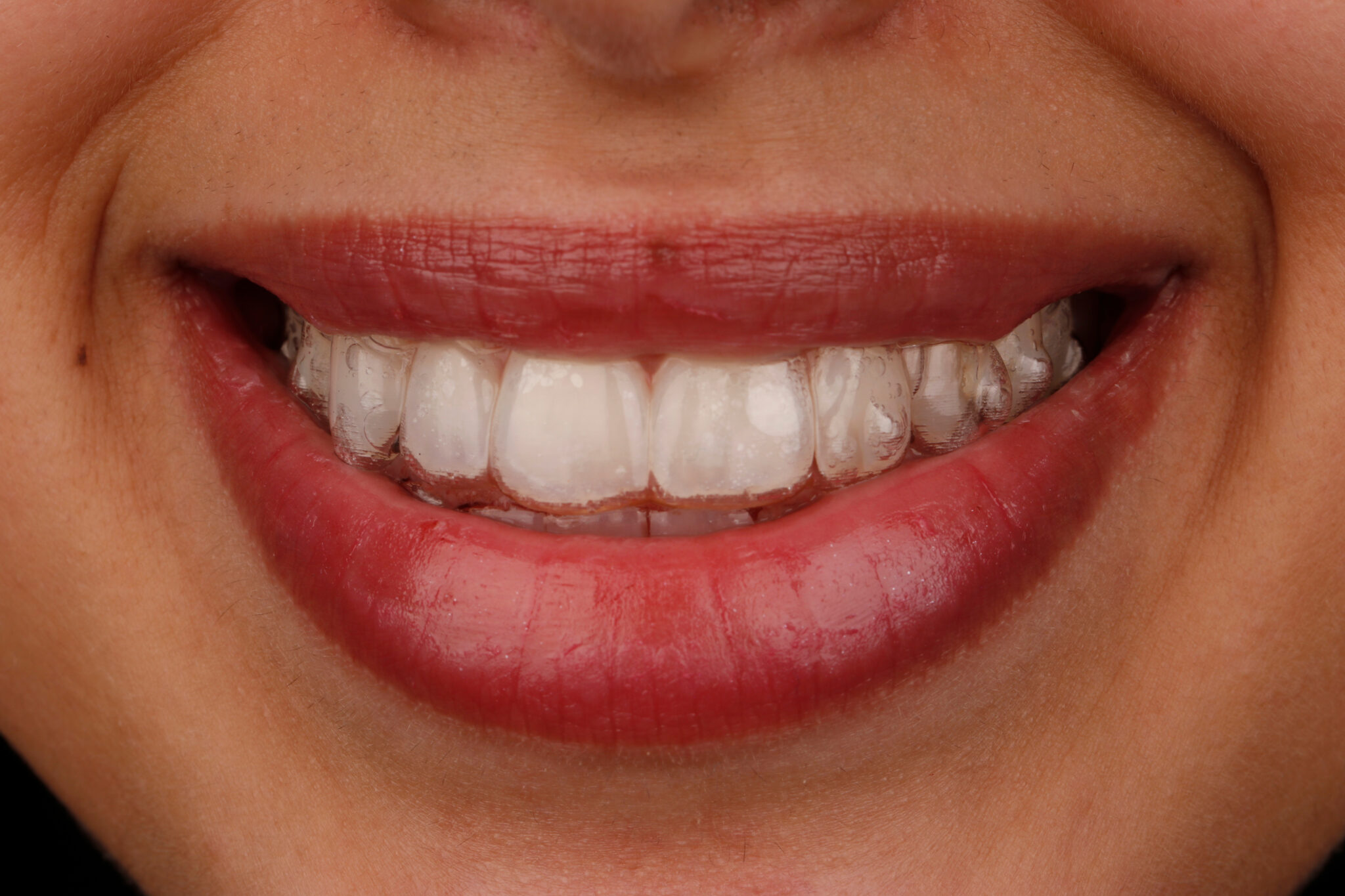 ORTHODONTIC TREATMENT WITH INVISALIGN … Is this an easy Procedure