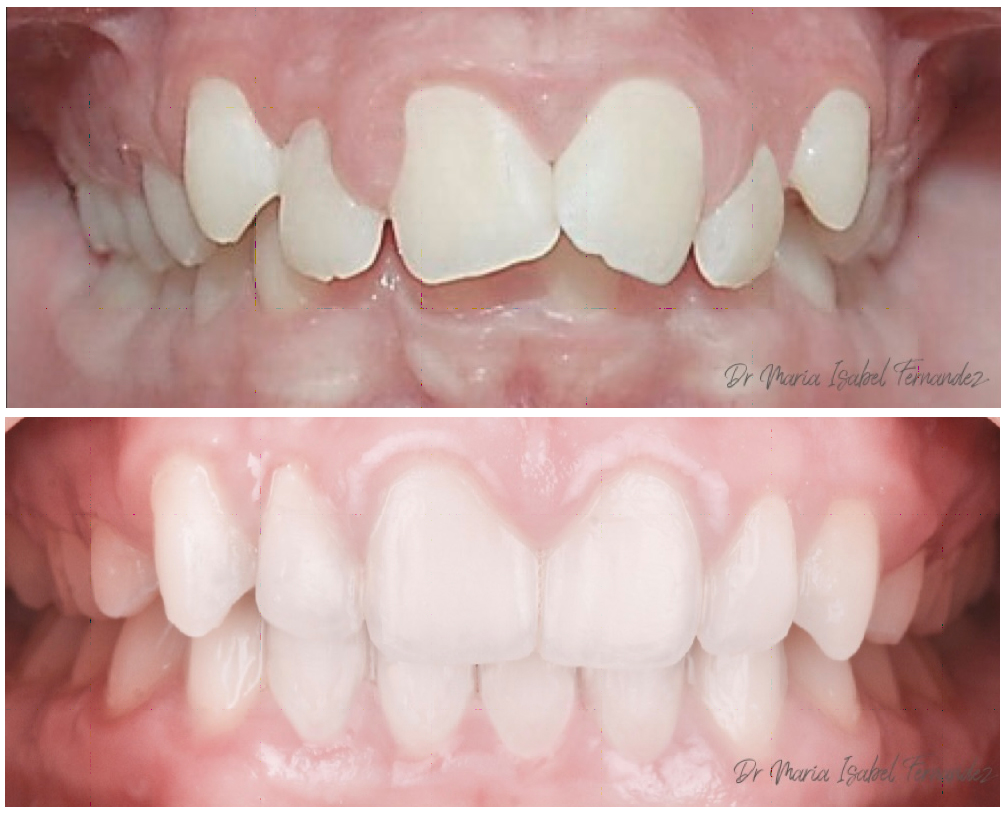 6 DIFFERENT TYPES OF BITE PROBLEMS THAT REQUIRE ORTHODONTIC TREATMENT